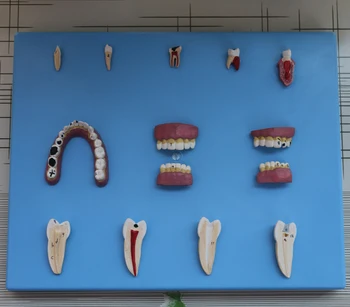 Zobni Patološkega Serija Model